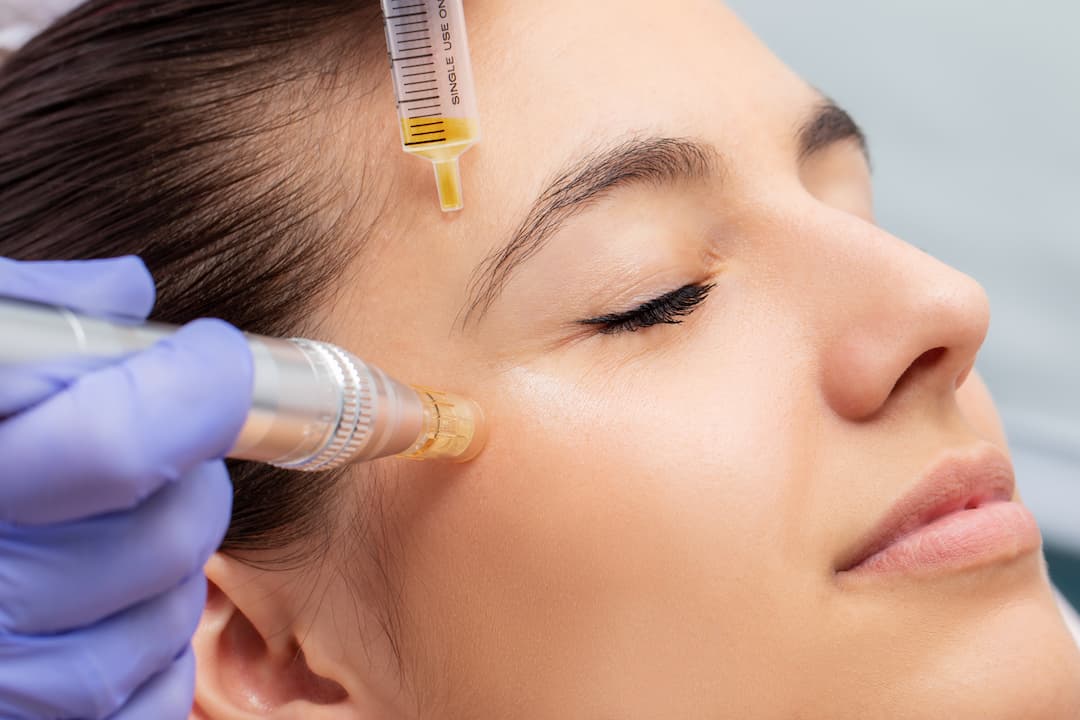 Woman having a microneedling treatment