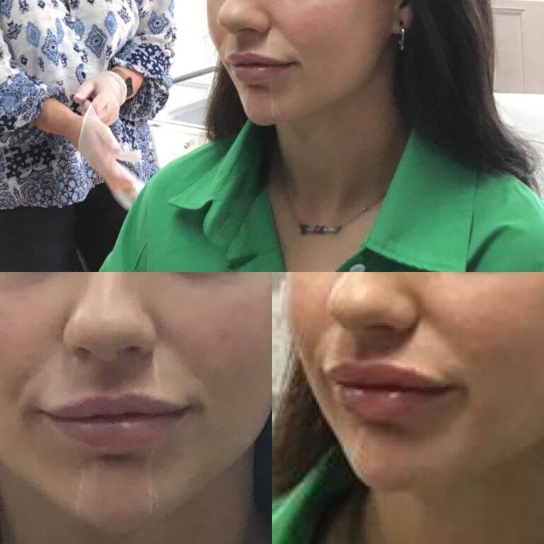 Lip filler results