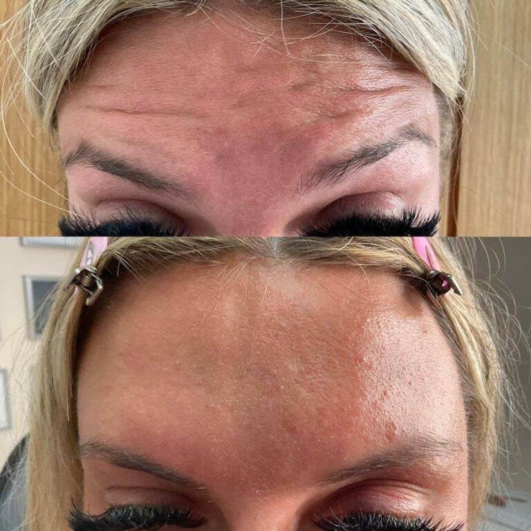 Forehead before and after anti-wrinkle botox injections