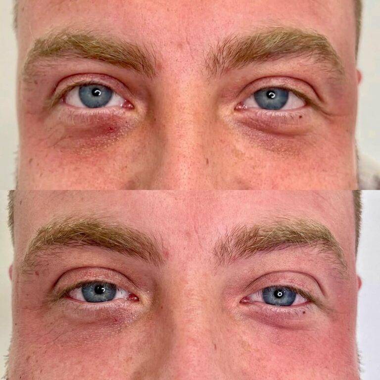 Before and after tear trough dermal filler