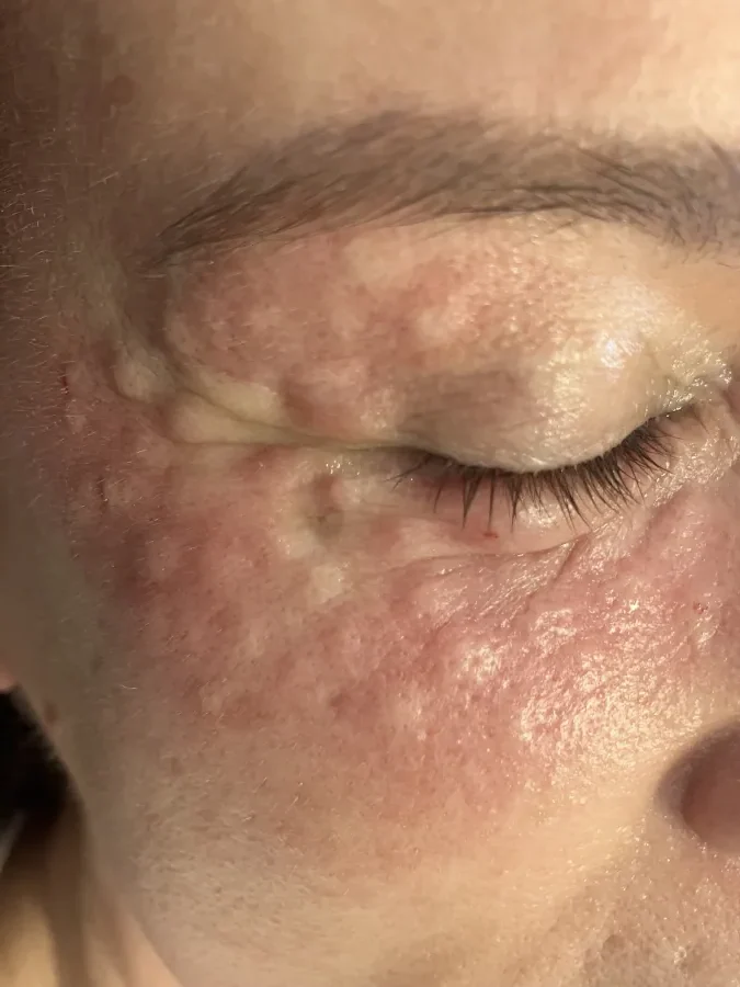 face with injection area