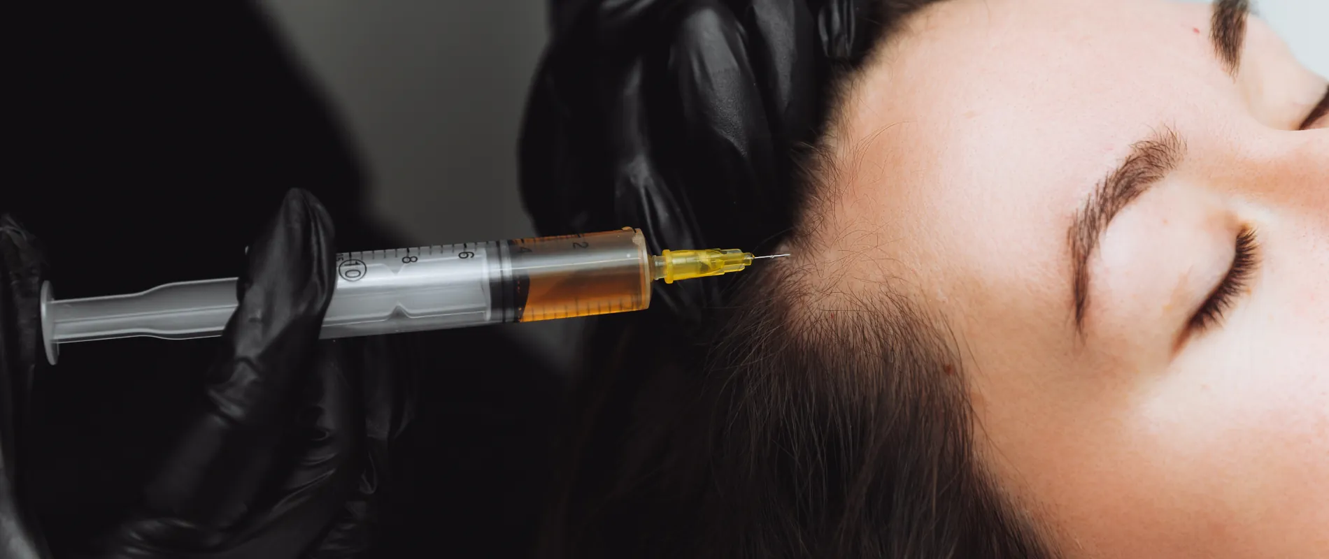 Hair Restoration Injection