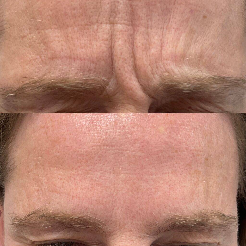 Forehead before and after anti wrinkle treatment