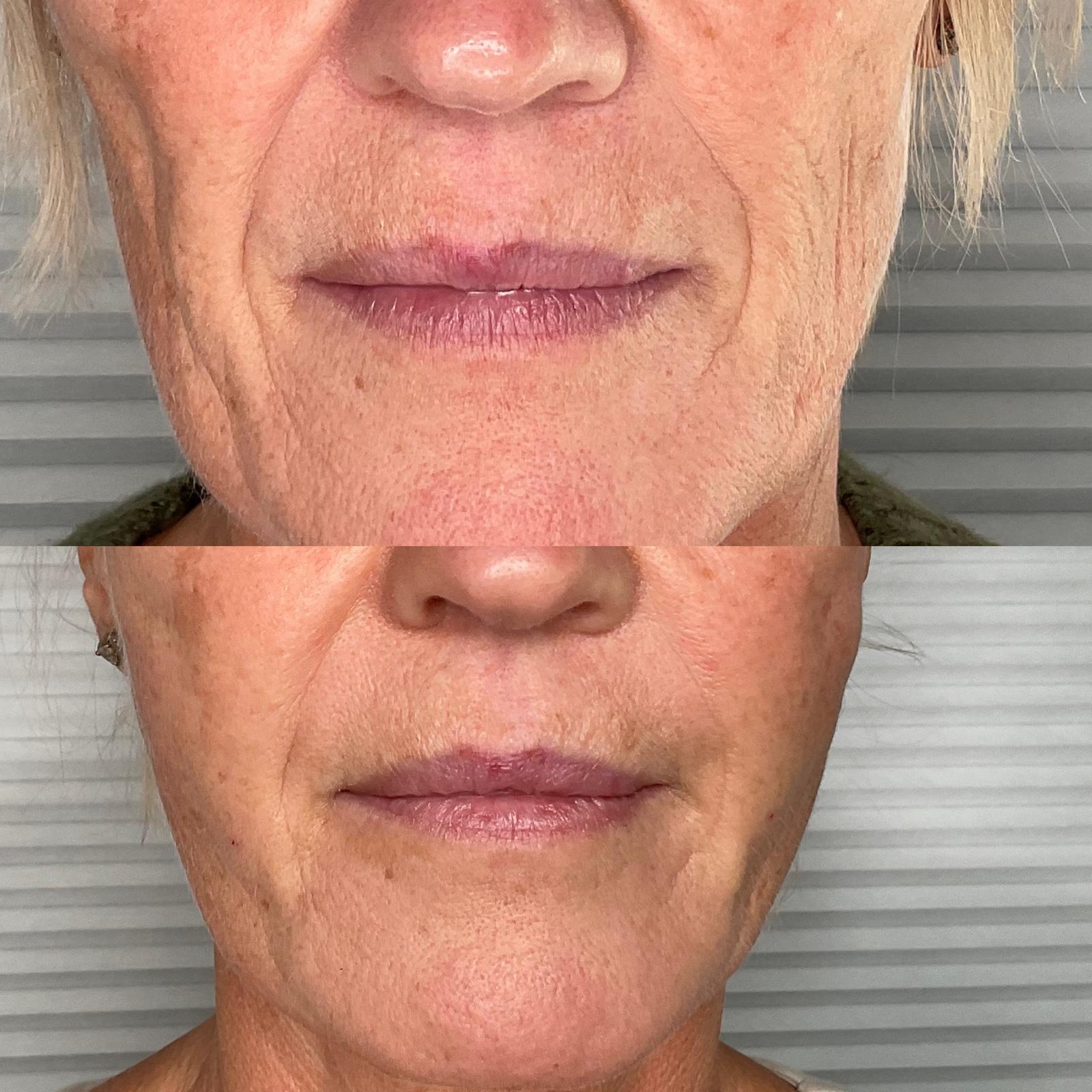 Dermal Filler 5