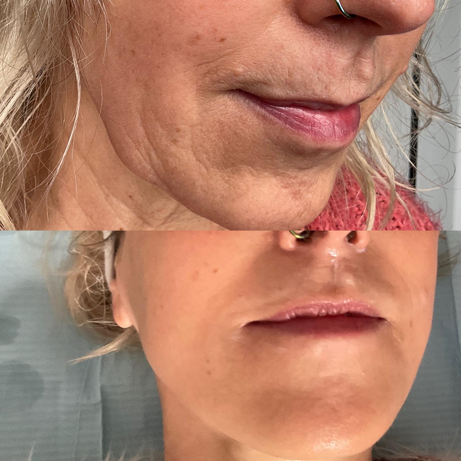 Dermal Filler