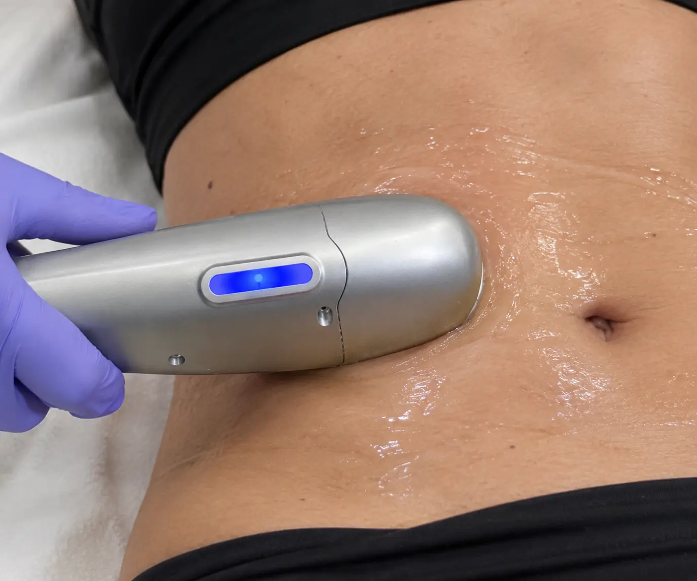 Ultrasound Hifu Treatment On Stomach
